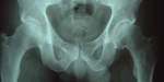 xray of hips